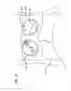 Fig. 30 - Robotic surgical systems with fluid flow control for irrigation, aspiration, and blowing