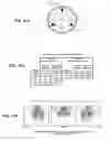 Fig. 12 - System for dissociation and removal of proteinaceous tissue
