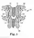 Fig. 02 - Instrument for pedicle screw adhesive materials