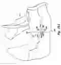 Fig. 11 - Bone fixation device and method