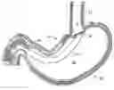 Fig. 01 - Method and device for use in endoscopic organ procedures