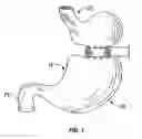 Fig. 02 - Method and device for use in endoscopic organ procedures