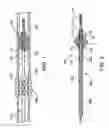 Fig. 02 - Polymer marker and retention bands