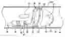 Fig. 01 - Expandable emboli filter and thrombectomy device