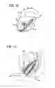Fig. 07 - Device for attaching, relocating and reinforcing tissue and methods of using same