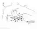 Fig. 01 - Subcutaneous ICD with motion artifact noise suppression