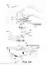 Fig. 02 - Subcutaneous ICD with motion artifact noise suppression