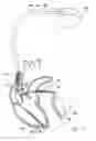 Fig. 02 - Mode switching heart stimulation apparatus and method