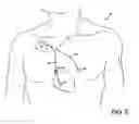 Fig. 03 - System and method for regulating blood pressure and electrolyte balance