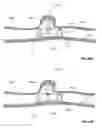 Fig. 48 - Lumen-traveling device