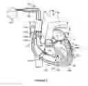 Fig. 08 - Dilating lead tip