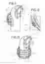 Fig. 06 - METHODS FOR LEAD PLACEMENT ON A SURFACE OF THE HEART