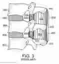 Fig. 04 - Facet joint and spinal ligament replacement