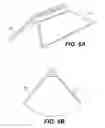 Fig. 05 - Intervertebral disc annulus stent