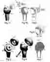 Fig. 02 - Shoulder joint prosthetic system