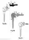 Fig. 04 - Shoulder joint prosthetic system