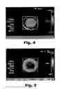Fig. 05 - Induction sealing heat profile improvement