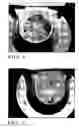 Fig. 06 - Compressor piston ball pocket coating