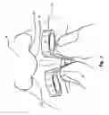 Fig. 03 - Clip-in nostril expander