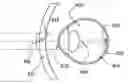 Fig. 01 - Method and apparatus for controlling peripheral image position for reducing progression of myopia