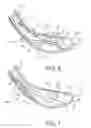 Fig. 06 - METHOD FOR TREATMENT OF MACULAR DEGENERATION