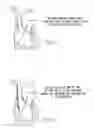 Fig. 02 - Percutaneous right ventricular assist apparatus and method