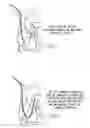Fig. 04 - Percutaneous right ventricular assist apparatus and method