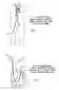 Fig. 05 - Percutaneous right ventricular assist apparatus and method