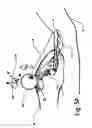 Fig. 06 - Micro vein enhancer