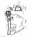 Fig. 09 - Micro vein enhancer