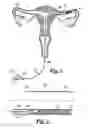 Fig. 02 - Hysteroscope Seal