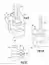 Fig. 06 - External fixation system