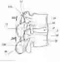 Fig. 01 - Device for stabilizing the spine