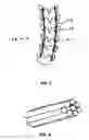 Fig. 05 - Spinal fusion using rods of shape memory material