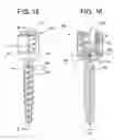 Fig. 17 - Instruments and methods for manipulating vertebra
