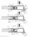Fig. 09 - Orthopaedic device with locking barrel