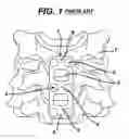 Fig. 02 - Spinal plate and drill guide