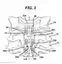 Fig. 03 - Spinal plate and drill guide
