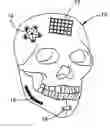Fig. 01 - Method and apparatus for treatment of bones
