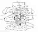 Fig. 01 - Methods and apparatuses for promoting fusion of vertebrae