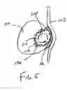 Fig. 06 - Internal pedicle insulator apparatus and method of use