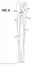 Fig. 08 - Modular tapered reamer for bone preparation and associated method