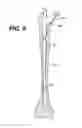 Fig. 09 - Modular tapered reamer for bone preparation and associated method