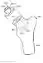 Fig. 01 - Method of preparing an acetabulum for receiving a head of a femoral prosthesis