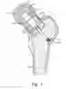 Fig. 02 - Method of preparing an acetabulum for receiving a head of a femoral prosthesis