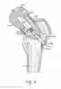 Fig. 07 - Method of preparing an acetabulum for receiving a head of a femoral prosthesis