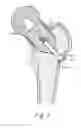 Fig. 08 - Method of preparing an acetabulum for receiving a head of a femoral prosthesis