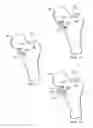Fig. 13 - Method of preparing an acetabulum for receiving a head of a femoral prosthesis