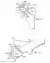 Fig. 15 - Method of preparing an acetabulum for receiving a head of a femoral prosthesis