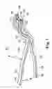 Fig. 02 - Spinal distraction and endplate preparation device and method